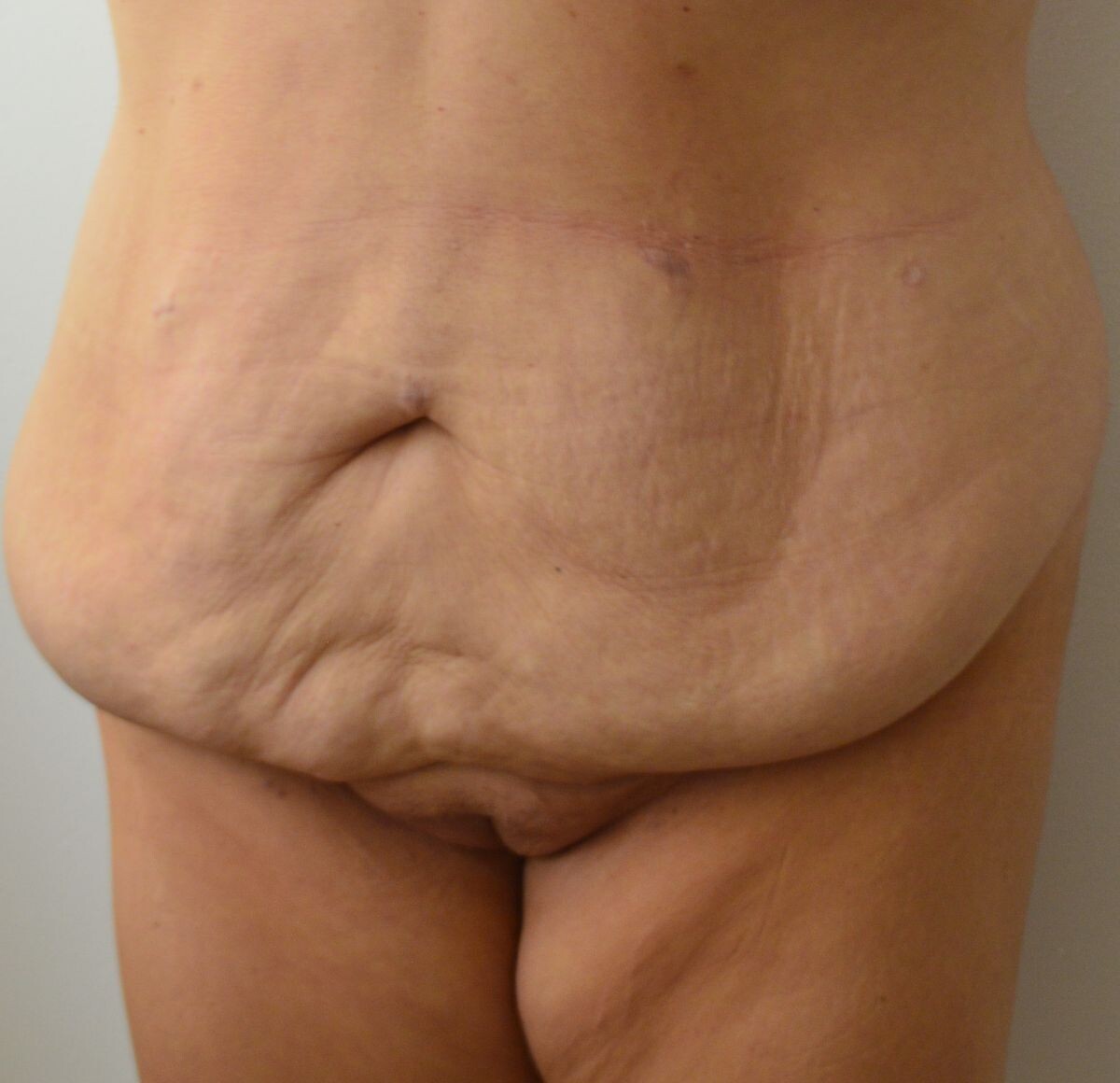 Chirurgie Post Bariatrică - pt. piele in exces dupa slabit