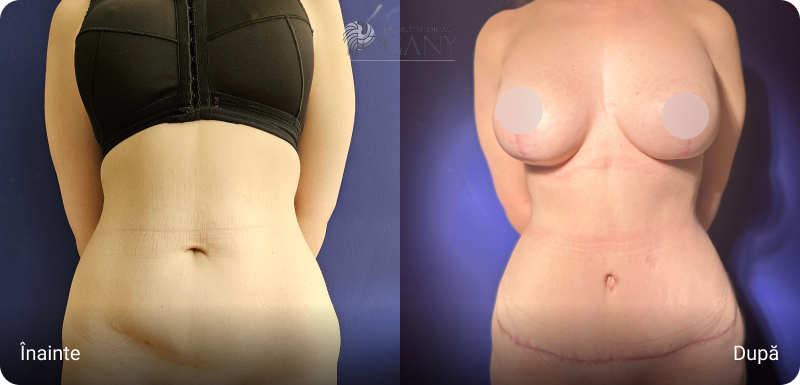 Abdominoplastie cazuri 1 1