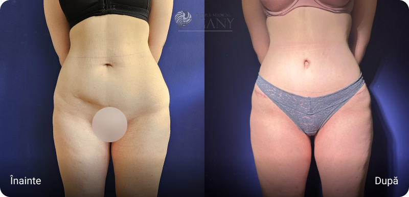 Abdominoplastie cazuri 1 3