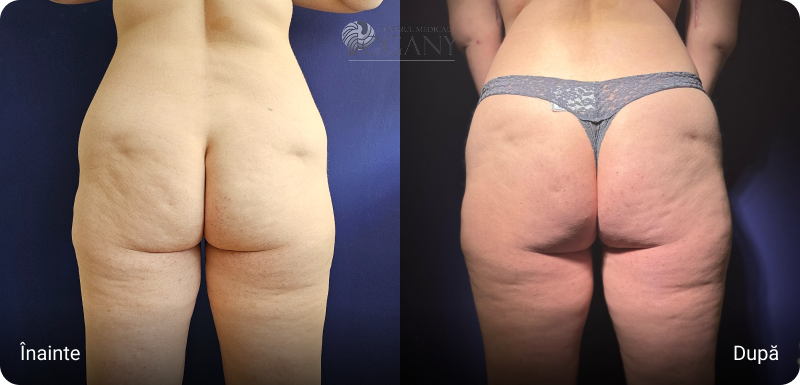Abdominoplastie cazuri 1 4