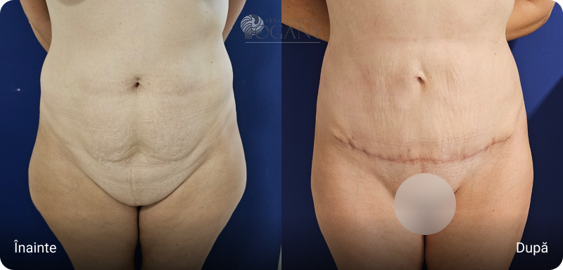 Abdominoplastie cazuri 2 1