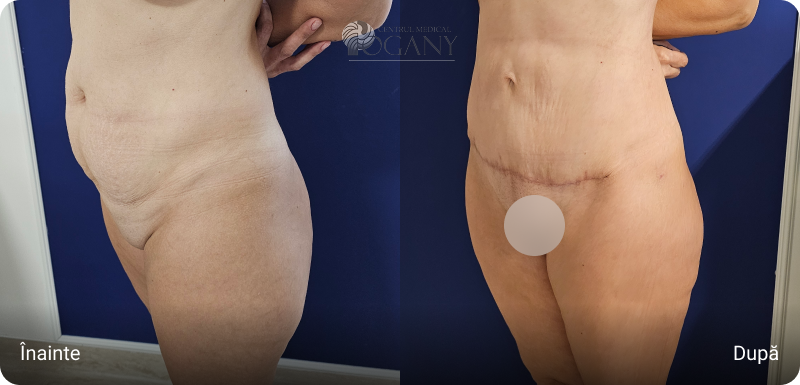 Abdominoplastie cazuri 2 3