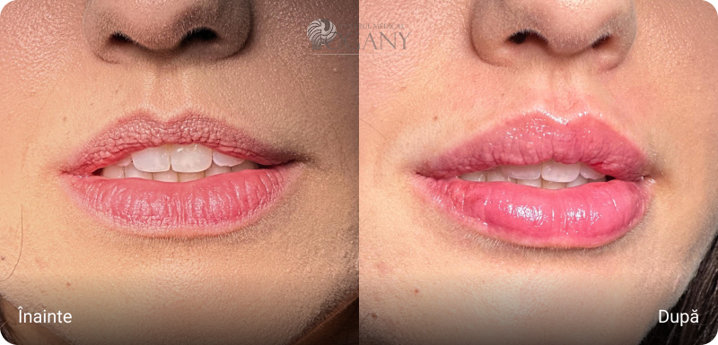 Mărire buze cazuri 1