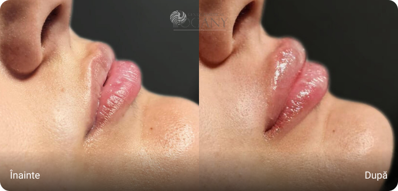 Mărire buze cazuri 2