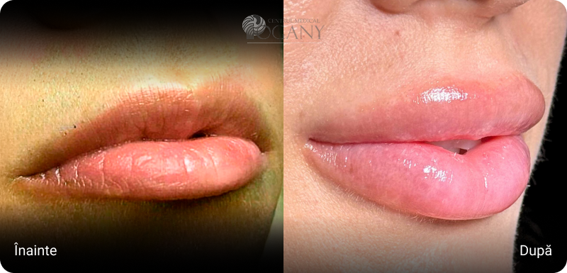Mărire buze cazuri 3