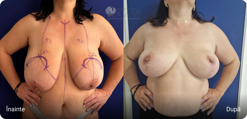 Ridicare sani cazuri 1 1