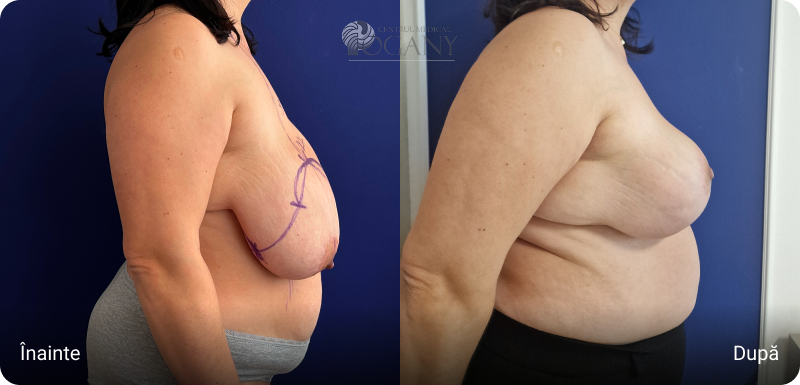 Ridicare sani cazuri 1 5