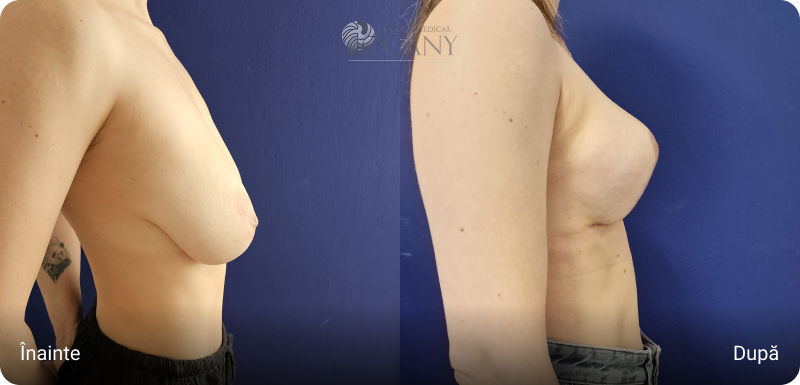 Ridicare sani cazuri 2 3