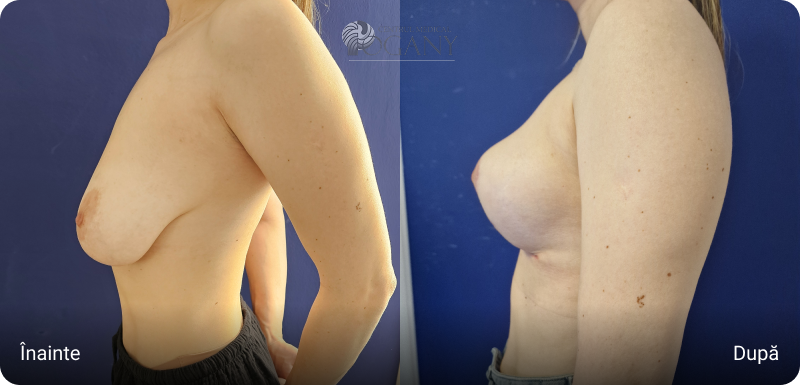 Ridicare sani cazuri 2 5