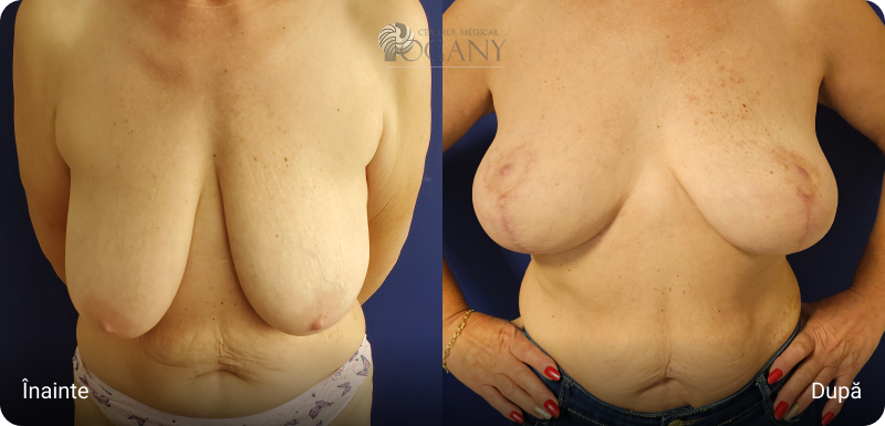 Ridicare sani cazuri 3 1