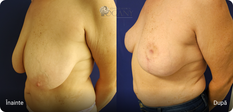 Ridicare sani cazuri 3 2