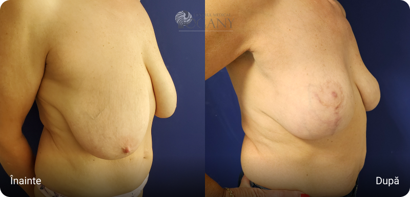 Ridicare sani cazuri 3 4