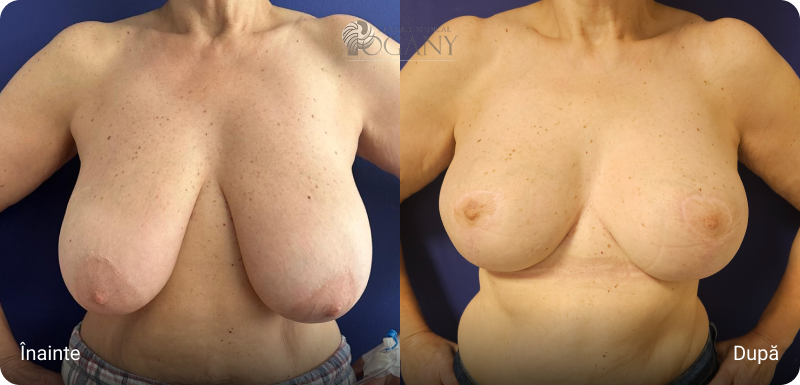 Ridicare sani cazuri 4 1