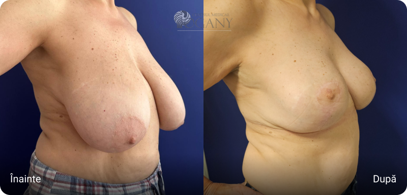 Ridicare sani cazuri 4 2