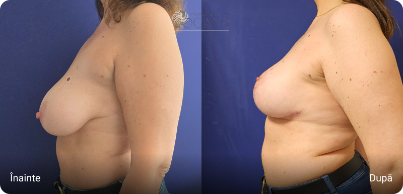 Ridicare sani cazuri 5 3