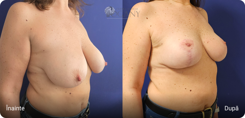 Ridicare sani cazuri 5 4