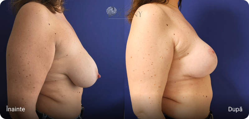 Ridicare sani cazuri 5 5