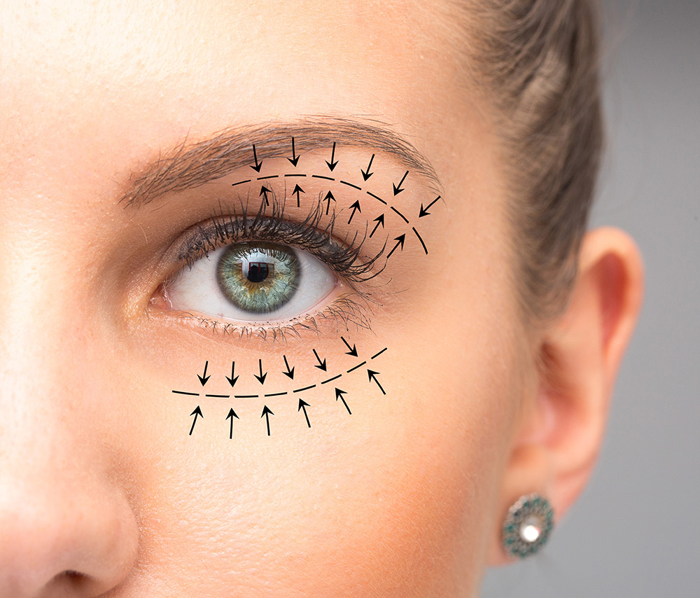 blefaroplastie pret operatie blefaroplastie pleoape cazute blefaroplastie ce este