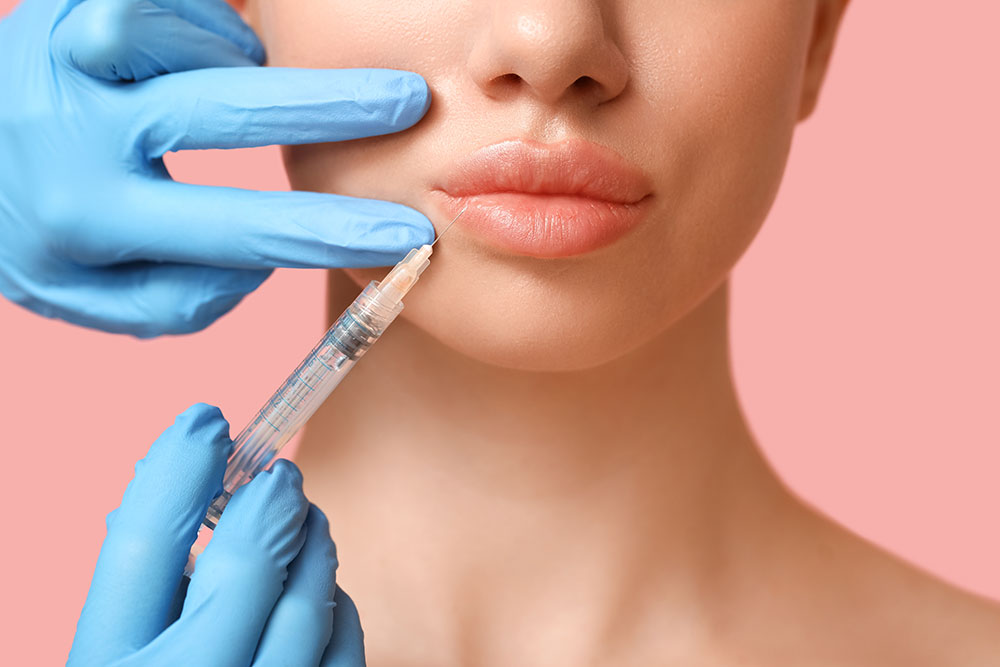 Acid hialuronic buze tip de filler